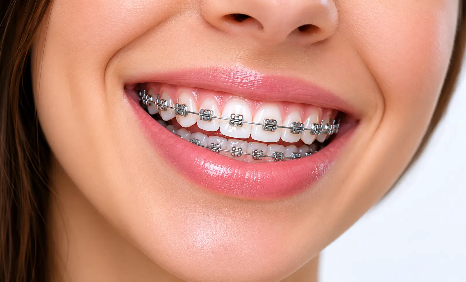 Ortodoncia y brackets