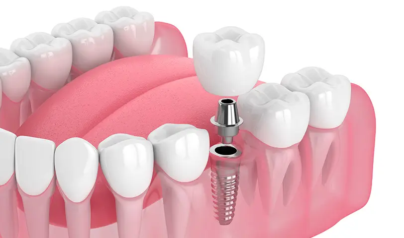 Implantes dentales