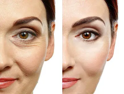 Bótox y estética facial