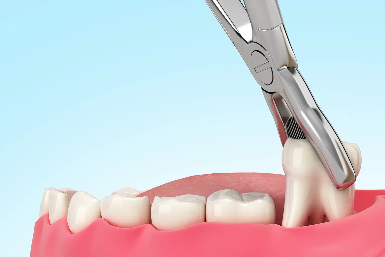 Extracciones y urgencias dentales