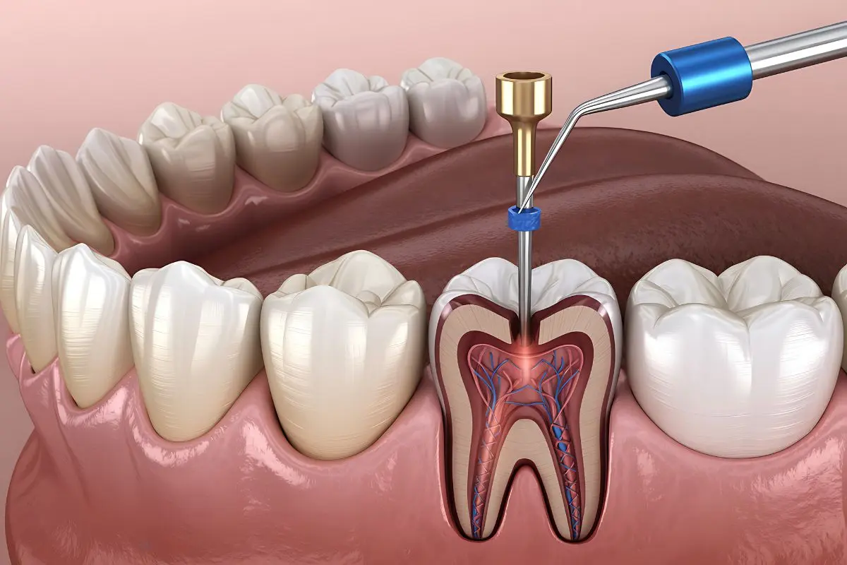 Endodoncia tratamiento de conducto