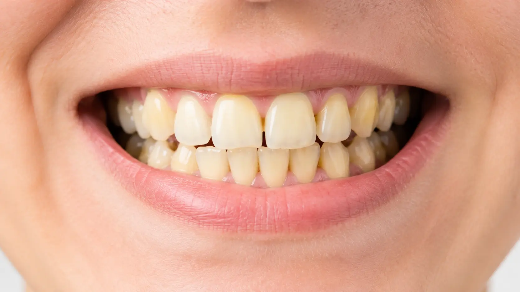 Antes del tratamiento dental